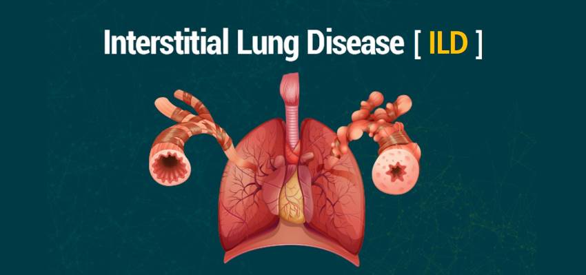 interstitial lung disease ILD